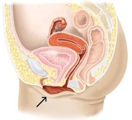 <strong>In this picture, the arrow is pointing to the </strong> A) vaginal orifice. B) labia minora. C) clitoris. D) labia majora.