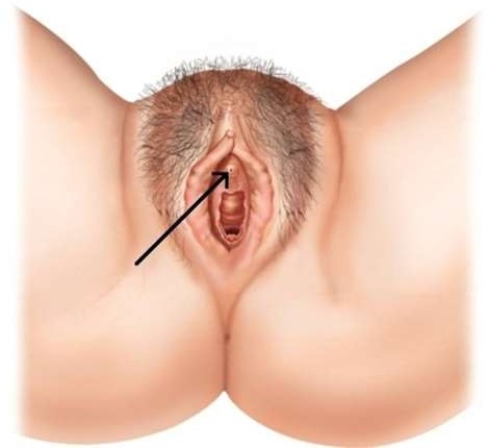 <strong>In the picture below, the arrow is pointing to the </strong> A) clitoris. B) urethal opening. C) vestibule. D) labia minora.