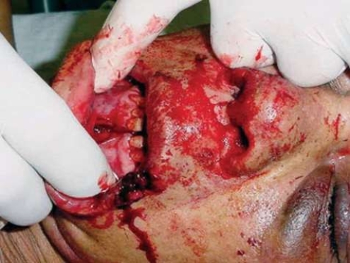 <strong>What statement is correct about this type of injury? </strong> A) Significant loss of blood is not a concern with this injury. B) This injury may destabilize the position of the tongue. C) Spinal stabilization is not always recommended for this injury. D) Teeth lost in this injury must be handled by the root.