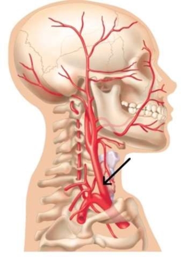<strong>The structure which is referred to in this image, responsible for the arterial blood supply to the face, is the_________ carotid artery. </strong> A) superior B) common C) external D) internal