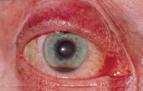 <strong>Which of the followings statements is correct about the pictured condition? </strong> A) Patients may develop this type of condition without suffering eye trauma. B) A patient's eyesight typically remains unaffected by this condition. C) Elevating a patient's head should be avoided when treating this condition. D) This type of condition requires patching only the injured eye to reduce bleeding.