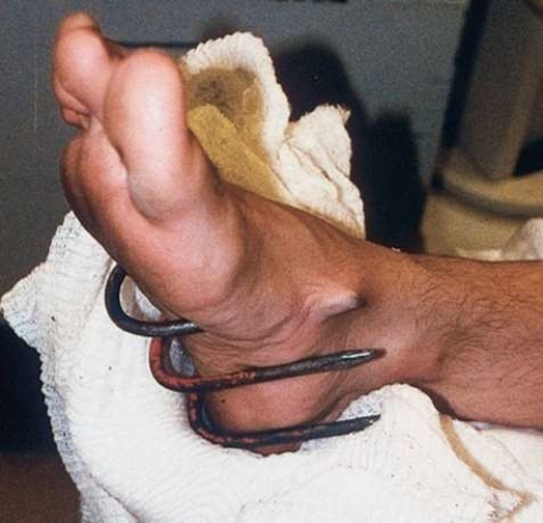 This puncture wound would most likely be at risk for  