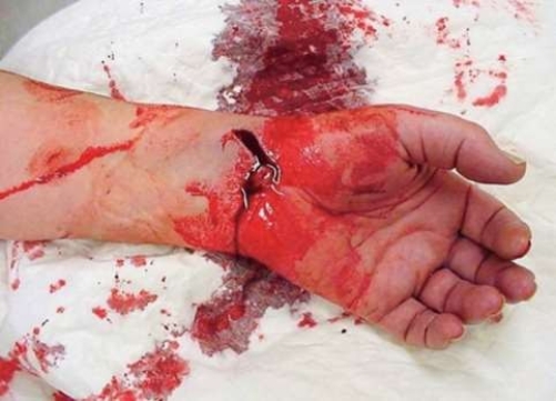 <strong>When treating this injury, you should first </strong> A) compress the brachial pressure point. B) irrigate the wound. C) elevate the limb. D) apply direct pressure.