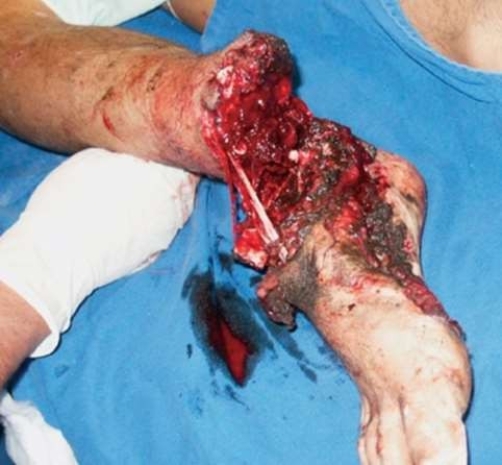 Explain the lack of blood in this amputation injury.  