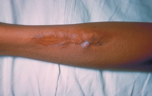 <strong>This picture depicts: </strong> A) a leg ulcer. B) frost bite. C) hand-foot syndrome. D) hemophilia.