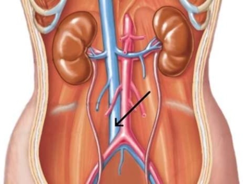 <strong>In the picture below, the arrow is pointing to the </strong> A) aorta. B) inferior vena cava. C) renal vein. D) renal artery.