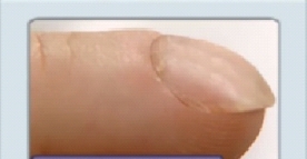 On assessment, the nurse notes the patient's fingernails appear as shown. What statement by the nurse is correct?