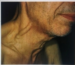 <strong>What does the nurse understand about this finding, seen in a hospitalized client? </strong> A) This is normal for an older client. B) This demonstrates jugular venous distention. C) This shows a carotid bruit. D) This demonstrates a deviated trachea.