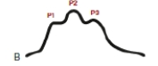 <strong>The nurse is caring for a client whose intracranial pressure waveform appears as shown. What action by the nurse is best? </strong> A) Calculate the client's CPP. B) Ensure the client's neck is midline. C) Document the findings in the chart. D) Call an RRT.