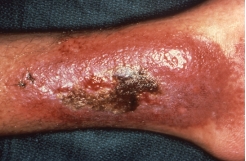 This is a picture of what AIDS-related condition?