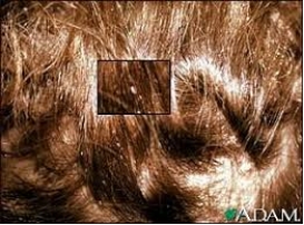 <strong>The nursing assistant examines the client's scalp while preparing to groom their hair and sees the following: What action should the nursing assistant take?</strong> A) Use an antidandruff shampoo. B) Report the observation to the nurse. C) Wear gloves when brushing hair. D) Apply a hair conditioner for dry hair.