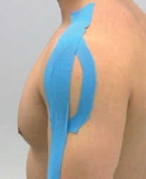<strong>What pathology of the shoulder is being addressed in the figure? </strong> A) Acromioclavicular separation B) Bicipital tendon impingement C) Shoulder instability D) Shoulder impingement E) Deltoid strain