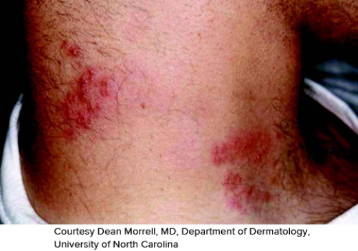 <strong>A patient presents with the skin condition demonstrated in the figure. It seems to be following an area that is consistent with dermatome T6. What could be wrong with this patient? </strong> A) Herpes simplex labialis B) Herpes simplex gladiatorum C) Herpes zoster D) Verruca virus E) Molluscum contagiosum