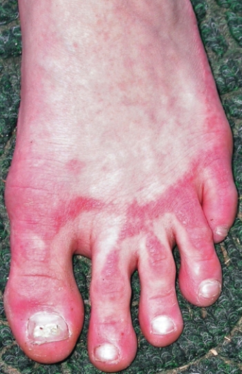 <strong>A freshman volleyball player presents with a skin condition demonstrated in the figure. What is wrong with this athlete? </strong> A) Contact dermatitis B) Scabies C) Hives D) Measles E) Mumps