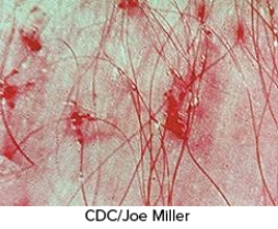 <strong>You notice that a patient is constantly scratching the head. Upon further investigation you see the sores demonstrated in this figure. What could be wrong with this patient? </strong> A) Scabies B) Pediculosis C) Tick bites D) Spider bite E) Pityriasis rosea