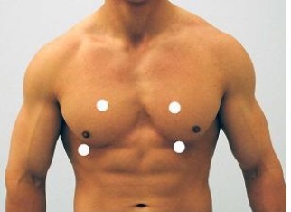 <strong>Which figure below correctly shows the four sites used for auscultation of heart sounds?</strong> A) B) C) D) E)