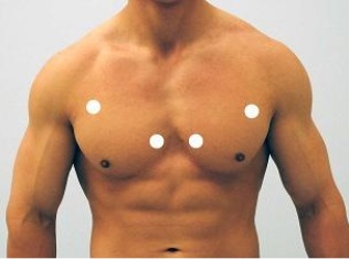<strong>Which figure below correctly shows the four sites used for auscultation of heart sounds?</strong> A) B) C) D) E)