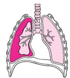 <strong>The figure demonstrates which of the following lung injuries? </strong> A) Pneumothorax B) Tension pneumothorax C) Hemothorax D) Traumatic asphyxia E) Hyperventilation