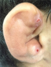 <strong>The problem demonstrated in this figure of the ear is commonly referred to as which of the following? </strong> A) Auricular hematoma B) Otitis externa C) Otitis media D) Pinna E) Impacted cerumen