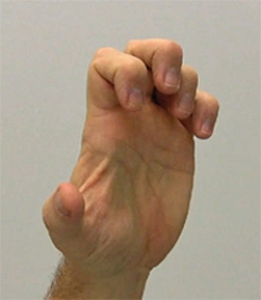 <strong>If a patient is suffering from the problem noted in the figure of the hand, which nerve would be damaged? </strong> A) The ulnar nerve B) The radial nerve C) The median nerve D) The axillary nerve E) The musculocutaneous nerve