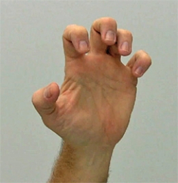 <strong>If a patient is suffering from the problem noted in the figure of the hand, which nerves would be damaged? </strong> A) Ulnar nerve and radial nerve B) Radial nerve and median nerve C) Median nerve and ulnar nerve D) Ulnar nerve and musculocutaneous nerve E) Musculocutaneous nerve and median nerve