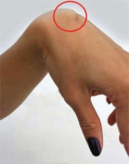 <strong>What problem or condition is noted in this figure of the wrist, hand, and finger? </strong> A) A hamate fracture B) A wrist ganglion C) A dislocated lunate D) Triangular fibrocartilage complex injury E) Colle's fracture