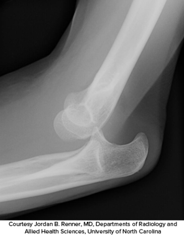 <strong>In the following image of the elbow, which of the following injuries has been sustained? </strong> A) Elbow subluxation B) Elbow fracture C) Posterior elbow dislocation D) Anterior elbow dislocation E) Radial/ulnar dislocation