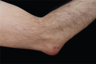 <strong>What condition is illustrated in the following image of the elbow? </strong> A) Olecranon contusion B) Capsular tear C) Olecranon bursitis D) Ligament sprain E) Infection