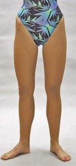 <strong>Based on this picture, what is most likely wrong with this person? </strong> A) Femoral retroversion B) Femoral anteversion C) Pathological sacroiliac joint dysfunction D) Leg-length discrepancy E) Tightness of the rectus femoris
