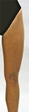 <strong>What is being measured in this illustration? </strong> A) The girth of the femur. B) The length of the femur. C) The diameter of the patella. D) The A angle. E) The Q angle.