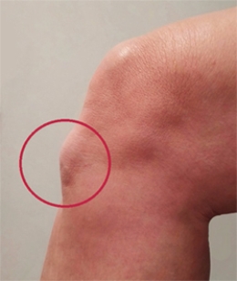 <strong>Based on this picture, what is the patient's condition? </strong> A) Osgood Schlatter's disease B) Larsen-Johansson disease C) Jumper's knee D) Cyclist's knee E) Patellofemoral stress syndrome