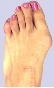<strong>This figure demonstrates which of the following conditions? </strong> A) Sesamoiditis B) Pes cavus C) Pes planus D) Metatarsalgia E) Hallux valgus deformity