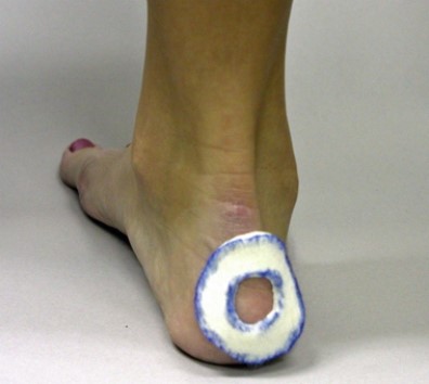 <strong>This type of pad (see below) can be used to treat all of the following problemsEXCEPT for which condition? </strong> A) Heel contusion B) Retrocalcaneal bursitis C) Hallux valgus deformity D) A blister E) Morton's neuroma