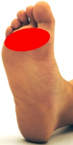 <strong>Please identify the area where callus develops on a person who is suffering from metatarsalgia.</strong> A) B) C) D) E)
