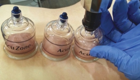 <strong>Please check all of the therapeutic reasons that this technique can be utilized. </strong> A) Improve blood flow B) Increase edema C) Reduce swelling D) Elongate muscles E) Reduce pain F) Treat scar tissue in connective tissue G) Reduce hematoma H) Decrease nerve conduction velocity