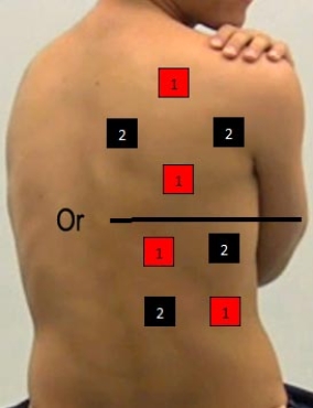 <strong>Identify the correct pad placement to administer interferential currents on the back.</strong> A) B) C) D) E)
