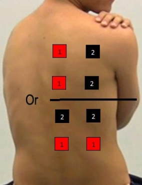 <strong>Identify the correct pad placement to administer interferential currents on the back.</strong> A) B) C) D) E)