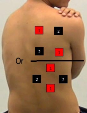 <strong>Identify the correct pad placement to administer interferential currents on the back.</strong> A) B) C) D) E)