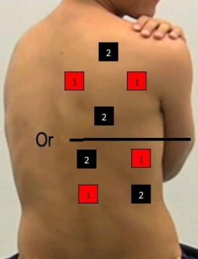 <strong>Identify the correct pad placement to administer interferential currents on the back.</strong> A) B) C) D) E)