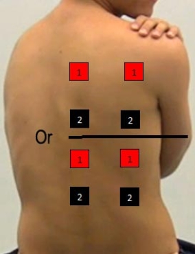 <strong>Identify the correct pad placement to administer interferential currents on the back.</strong> A) B) C) D) E)