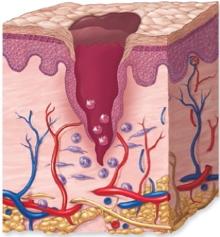 <strong>Based on the figure, what is occurring during this process of the inflammatory response phase?  </strong> A) Epithelium is regenerating. B) Granulation of tissue is forming. C) Blood is leaking into deeper tissues. D) Leukocytes are cleaning the wound. E) Clot formation is finalizing. <div style=padding-top: 35px> 