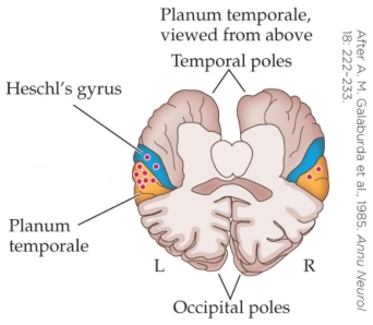 <strong>Refer to the figure. Consider a patient whose brain scan resembles the figure. Which statement represents the most likely diagnosis?</strong> A) The left planum temporale is the same size as the right, so the patient is likely dyslexic. B) Heschl's gyrus is much smaller than the planum temporale, so the patient is likely dyslexic. C) The figure shows that there are more neurons in the left than the right planum temporale, thus this patient likely does not have dyslexia. D) The planum temporale is larger than Heschl's gyrus, thus this patient likely does not have dyslexia.
