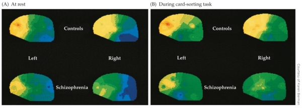 <strong>Refer to the figure showing PET scans of twins in which one is affected with schizophrenia and one is not. The activation patterns suggest _______ activation in the frontal cortex of the affected twin, both at rest and during the Wisconsin Cart Sorting Test.</strong> A) less B) more C) equal D) no