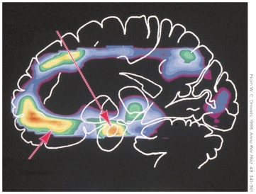 <strong>Refer to the figure. Compared with the data from controls, PET scans of patients with depression show</strong> A) decreases in blood flow in the prefrontal cortex and amygdala. B) increases in blood flow in the prefrontal cortex and amygdala. C) increases in blood flow in the prefrontal, temporal, and parietal cortexes. D) hypofrontality.