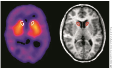<strong>Refer to the figure showing PET scans of patients with Tourette's syndrome. These scans show greater density of dopamine receptors in the</strong> A) basal ganglia. B) limbic system. C) cerebellum. D) spinal cord.