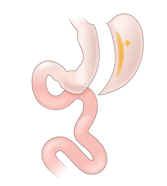 <strong>Refer to the figure.   A patient elected to have the surgery illustrated in the figure to treat their type II diabetes. What kind of surgery did the patient choose?</strong> A) Roux-en-Y gastric bypass surgery to reduce nutrient absorption and ghrelin secretion B) Sleeve gastrectomy to reduce nutrient absorption and ghrelin secretion C) Colectomy to reduce nutrient absorption. D) Gastrectomy to improve the gut microbiota <div style=padding-top: 35px> 