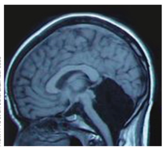 <strong>Refer to the figure. The individual depicted in the figure</strong> A) had their prefrontal cortex removed due to seizures, and they now have trouble deciding how to move. B) had their cerebellum removed due to seizures, and they now have trouble executing smooth movements. C) was born without a cerebellum, but because of neuroplasticity, they have no motor deficiencies. D) was born without a prefrontal cortex, but because of neuroplasticity, they have no difficulty deciding to move.