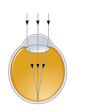 <strong>Refer to the figure.   An individual whose vision is illustrated by the figure</strong> A) has normal vision. B) has amblyopia. C) has myopia. D) is farsighted. <div style=padding-top: 35px> 