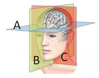 <strong>Refer to the figure. The plane labeled A is called the _______ plane, the plane labeled B is the _______, and the plane marked C is the _______.</strong> A) dorsal; sagittal; posterior B) sagittal; ipsilateral; coronal C) horizontal; sagittal; coronal D) coronal; horizontal; sagittal