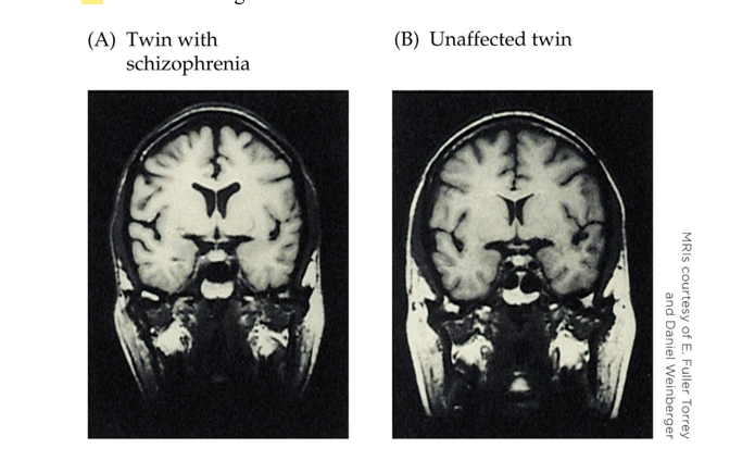 <strong>Refer to the figure. A researcher who is studying schizophrenia examines the images above. What sort of study is this researcher conducting?</strong> A) A study to determine causality B) A somatic intervention C) A behavioral intervention D) A correlational study
